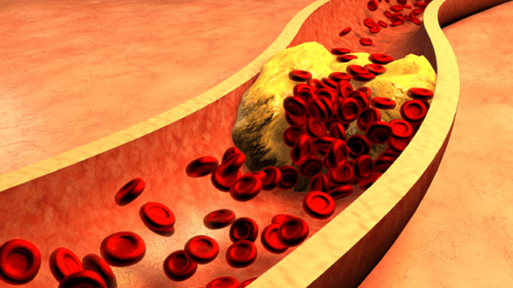 Hyperlipidemia Service