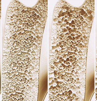 Osteoporosis