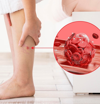 Venous Embolism and Thrombosis