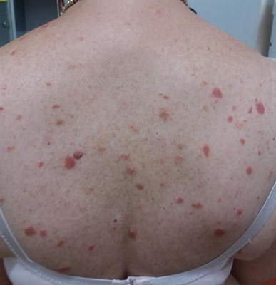 Sarcoidosis
