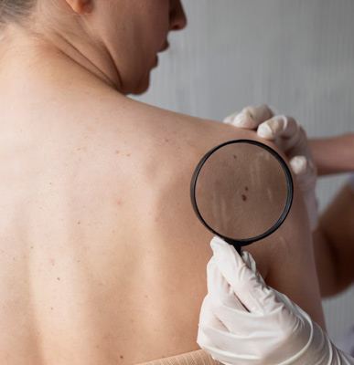 Skin Cancer